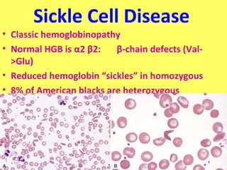 Sickle Cell Disease 
• Classic hemoglobinopathy 
• Normal HGB is α2 β2: β-chain defects (Val- 
>Glu) 
• Reduced hemoglobin “sickles” in homozygous 
• 8% of American blacks are heterozygous 
 