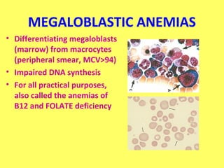 MEGALOBLASTIC ANEMIAS 
• Differentiating megaloblasts 
(marrow) from macrocytes 
(peripheral smear, MCV>94) 
• Impaired DNA synthesis 
• For all practical purposes, 
also called the anemias of 
B12 and FOLATE deficiency 
 