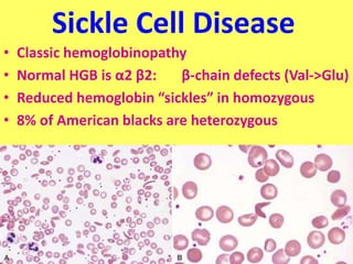 Sickle Cell Disease
• Classic hemoglobinopathy
• Normal HGB is α2 β2: β-chain defects (Val->Glu)
• Reduced hemoglobin “sickles” in homozygous
• 8% of American blacks are heterozygous
 