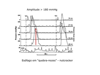 Amplitude > 180 mmHg




Esófago em “quebra-nozes” - nutcracker
 