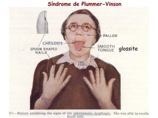 Síndrome de Plummer-Vinson




                         glossite
 