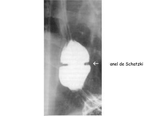anel de Schatzki
 