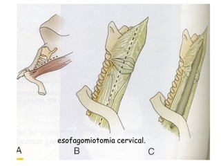 esofagomiotomia cervical.
 