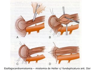 Esofagocardiomiotomia – miotomia de Heller c/ fundoplicatura ant. Dor
 