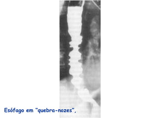 Esófago em “quebra-nozes”,
 