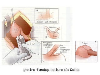 gastro-fundoplicatura de Collis
 