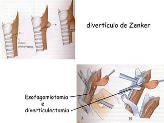 divertículo de Zenker




Esofagomiotomia
      e
diverticulectomia
 