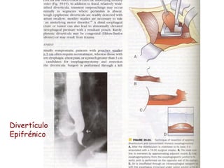 Divertículo
Epifrénico
 