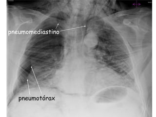 pneumomediastino




   pneumotórax
 