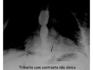 Trânsito com contraste não iónico
 