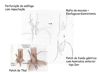 Perfuração do esófago
com impactação          Rafia da mucosa +
                        Esofagocardiomiotomia




                        Patch do fundo gástrico
                        com hemivalva anterior
                          tipo Dor

   Patch de Thal
 