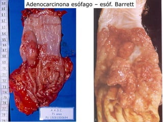 Adenocarcinona esófago – esóf. Barrett
 