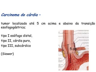 Carcinoma do cárdia –

tumor localizado até 5 cm acima e abaixo da transição
esofagogástrica;

tipo I esófago distal,
tipo II, cárdia puro,
tipo III, subcárdico
                                      5 cm
(Siewer)
 