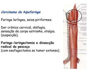 Carcinoma da hipofaringe

Faringe laríngea, seios piriformes.

Dor crónica cervical, disfagia,
sensação de corpo estranho, otalgia.
(suspeição).

Faringo-laringectomia e dissecção
radical do pescoço
(com esofagectomia se tumor extenso).
 
