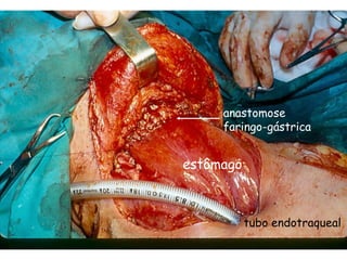 anastomose
     faringo-gástrica


estômago



           tubo endotraqueal
 