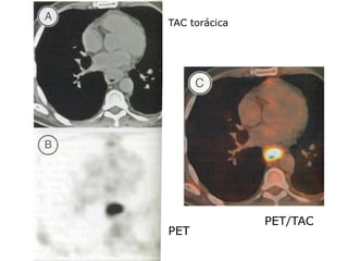 TAC torácica




               PET/TAC
PET
 