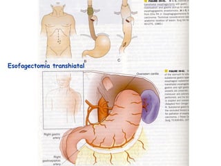 Esofagectomia transhiatal
 