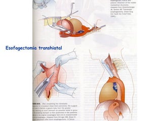 Esofagectomia transhiatal
 