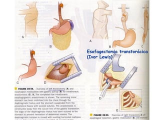 Esofagectomia transtorácica
(Ivor Lewis)
 
