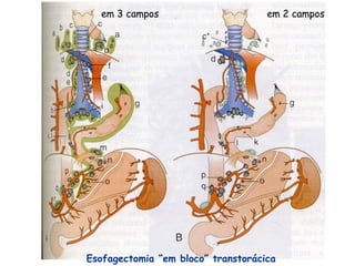 em 3 campos                       em 2 campos




Esofagectomia “em bloco” transtorácica
 