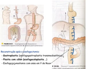 Reconstrução após a esofagectomia:
- Gastroplastia (esofagogastroplastia transmediastínica)
- Plastia com cólon (esofagocoloplastia ...)
- Esofagojejunostomia com ansa em Y de Roux
 
