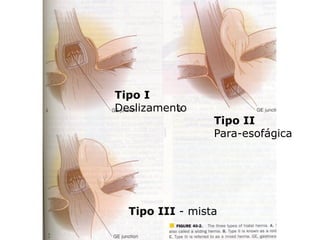 Tipo I
Deslizamento
                 Tipo II
                 Para-esofágica




  Tipo III - mista
 