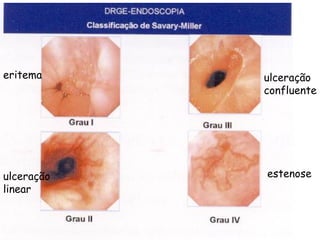 eritema     ulceração
            confluente




ulceração   estenose
linear
 