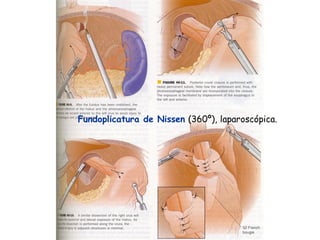 Fundoplicatura de Nissen (360º), laparoscópica.
 