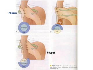 Nissen




         Toupet
 