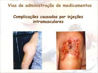 Vias de administração de medicamentos 
Complicações causadas por injeções 
intramusculares 
 