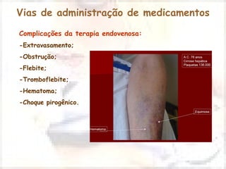 Vias de administração de medicamentos 
Complicações da terapia endovenosa: 
-Extravasamento; 
-Obstrução; 
-Flebite; 
-Tromboflebite; 
-Hematoma; 
-Choque pirogênico. 
 