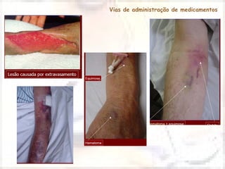 Vias de administração de medicamentos 
 