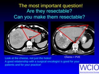 The most important question!The most important question!
Are they resectable?
Can you make them resectable?
Look at the cheese, not just the holes!
A good relationship with a surgical oncologist is good for your
patients and for your practice!
Chemo + PVE
 