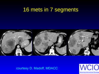 16 mets in 7 segments
courtesy D. Madoff, MDACC
 