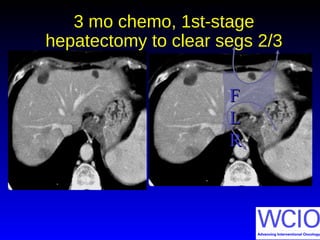 3 mo chemo, 1st-stage
hepatectomy to clear segs 2/3
FF
LL
RR
 
