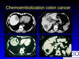 Chemoembolization colon cancerChemoembolization colon cancer
 