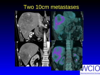 Two 10cm metastases
 