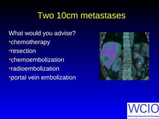 Two 10cm metastases
What would you advise?
•chemotherapy
•resection
•chemoembolization
•radioembolization
•portal vein embolization
 