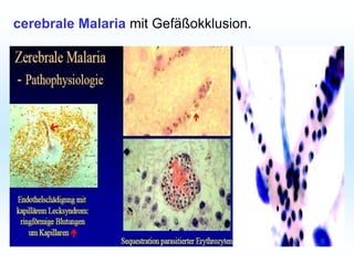 cerebrale Malaria mit Gefäßokklusion.
 