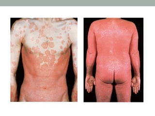 Pyrosis Define 130525 psoriasis pdf | PDF