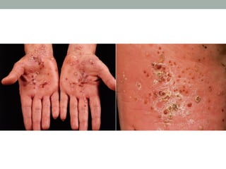 Pyrosis Define 130525 psoriasis pdf | PDF