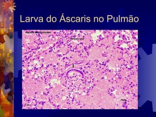 Larva do Áscaris no Pulmão
 