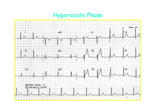 1308 ecg acs update | PDF