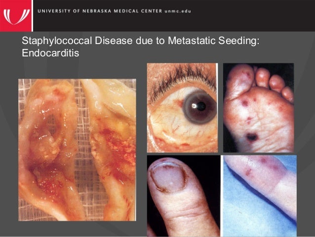 Dr. Paul Fey - Livestock-associated Staphylococcus aureus: Recent Tre…