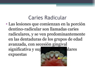 Caries Radicular
• Las lesiones que comienzan en la porción
dentino-radicular son llamadas caries
radiculares, y se ven predominantemente
en las dentaduras de los grupos de edad
avanzada, con secesión gingival
significativa y superficies radiculares
expuestas
 