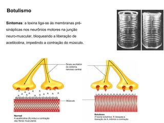 Botulismo
Sintomas: a toxina liga-se às membranas pré-
sinápticas nos neurônios motores na junção
neuro-muscular, bloqueando a liberação de
acetilcolina, impedindo a contração do músculo.
 