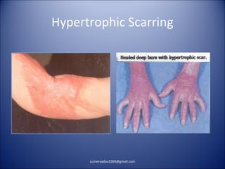 Hypertrophic Scarring
sumeryadav2004@gmail.com
 