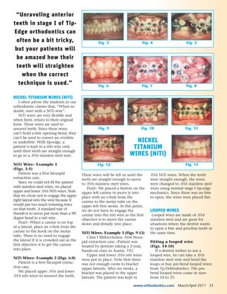 NICKEL TITANIUM WIRES (NiTi)
I often advise the students in our
orthodontic classes that, “When in
doubt, start with a NiTi wire”.
NiTi wires are very flexible and
when bent, return to their original
form. These wires are used to
unravel teeth. Since these wires
can’t hold a bite opening bend, they
can’t be used to correct an overbite
or underbite. With tip-edge, a
patient is kept in a niti wire only
until their teeth are straight enough
to go to a .016 stainless steel wire.
NiTi Wire– Example 1
(Figs. 3-5)
Patient was a first bicuspid
extraction case.
Since we could not fit the patient
with stainless steel wires, we placed
upper and lower .016 NiTi wires. Note
that we chose not to engage the upper
right lateral into the wire because it
would put too much torturing force
on that tooth. A standard rule of
thumb is to never put more than a 90
degree bend in a niti wire.
Pearl– When a canine is on top
of a lateral, place an e-link from the
canine to the hook on the molar
tube. There is no need to engage
the lateral if it is crowded out as the
first objective it to get the canine
into place.
NiTi Wires– Example 2 (Figs. 6-8)
Patient is a first bicuspid extrac-
tion case.
We placed upper .016 and lower
.014 niti wires to unravel the teeth.
These wires will be left in until the
teeth are straight enough to move
to .016 stainless steel wires.
Pearl– We placed a button on the
upper left canine to move it into
place with an e-link from the
canine to the molar tube on the
upper left first molar. At this point,
we do not have to engage the
canine into the niti wire as the first
objective is to move the canine
down and distally into place.
NiTi Wires– Example 3 (Figs. 9-13)
Class I Malocclusion. First bicus-
pid extraction case. (Patient was
treated by dentists taking a 2-year,
hands-on class in Austin, TX)
Upper and lower .016 niti wires
were put in place. Note that there
was not enough room to bracket
upper laterals. After six weeks, a
bracket was placed in the upper
laterals. The patient was kept in
.016 NiTi wires. When the teeth
were straight enough, the wires
were changed to .016 stainless steel
wires using normal stage I tip-edge
mechanics. Since there was no bite
to open, the wires were placed flat.
LOOPED WIRES
Looped wires are made of .016
stainless steel and are great for
situations where the dentist wants
to open a bite and procline teeth at
the same time.
Fitting a looped wire
(Figs. 14-18)
If a dentist wishes to use a
looped wire, he can take a .016
stainless steel wire and bend the
loops or buy pre-bend looped wires
from Tp Orthodontics. The pre-
bend looped wires come in sizes
from 10 to 25.
“Unraveling anterior
teeth in stage I of Tip-
Edge orthodontics can
often be a bit tricky,
but your patients will
be amazed how their
teeth will straighten
when the correct
technique is used.”
Fig. 3 Fig. 4 Fig. 5
Fig. 6 Fig. 7 Fig. 8
Fig. 9
Fig. 12 Fig. 13
Fig. 10 Fig. 11
www.orthodontics.com March/April 2011 51
NICKEL
TITANIUM
WIRES (NiTi)
 
