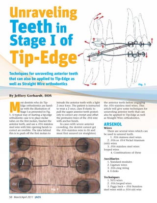 50 March/April 2011 JAOS
M
ost dentists who do Tip-
Edge orthodontics are famil-
iar with the illustration of
Stage I as presented in Fig.
1. A typical way of starting a tip-edge
orthodontic case is to place molar
tubes on the first molars, bracket the
anterior teeth, and use a .016 stainless
steel wire with bite opening bends to
correct an overbite. The idea behind
this is to push off the first molars to
intrude the anterior teeth with a light
2 once force. The patient is instructed
to wear a 2 once, class II elastic to
pull the upper anterior teeth posteri-
orly to correct any overjet and offset
the protrusive force of the .016 wire
with anchor bends.
In cases with severe anterior
crowding, the dentist cannot get
the .016 stainless wire to fit and
must first unravel (or straighten)
the anterior teeth before engaging
the .016 stainless steel wires. This
article will give some techniques for
unraveling anterior teeth that can
also be applied to Tip-Edge as well
as Straight Wire orthodontics.
ARSENOL
Wires
There are several wires which can
be used to unravel teeth.
1. .016 stainess steel wires
2. .016 or .014 Nickel titanium
(niti) wires
3. .016 stainless steel wires
looped wires
4. Combinations of these
Auxillaries
1. Standard modules
2. Ligature wires
3. .016 zing string
4. E-links
Techniques
1. NiTi wires
2. .016 looped wires
3. Piggy back – .016 Stainless
steel wires with a .014 niti wire
Unraveling
Teeth in
Stage I of
Tip-Edge
Unraveling
Teeth in
Stage I of
Tip-Edge
By Jeffery Gerhardt, DDS
Techniques for unraveling anterior teeth
that can also be applied to Tip-Edge as
well as Straight Wire orthodontics Fig. 1
Fig. 2
 