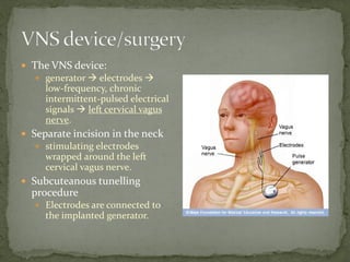 The VNS device:
 generator  electrodes 
low-frequency, chronic
intermittent-pulsed electrical
signals  left cervical vagus
nerve.
 Separate incision in the neck
 stimulating electrodes
wrapped around the left
cervical vagus nerve.
 Subcuteanous tunelling
procedure
 Electrodes are connected to
the implanted generator.
 